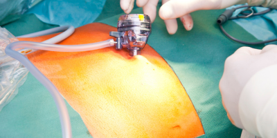 Laser & Minimally Invasive Ano-Rectal Care
